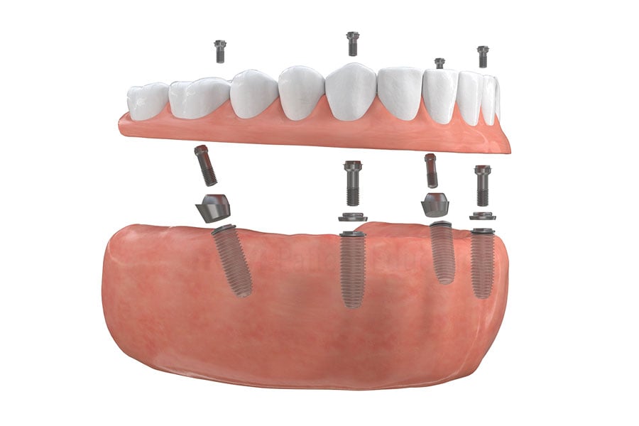 Dental Implant in Bourbonnais, IL