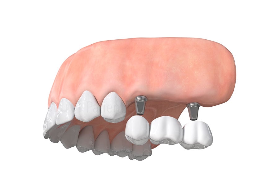 Dental Implant Bridge in Bourbonnais, IL