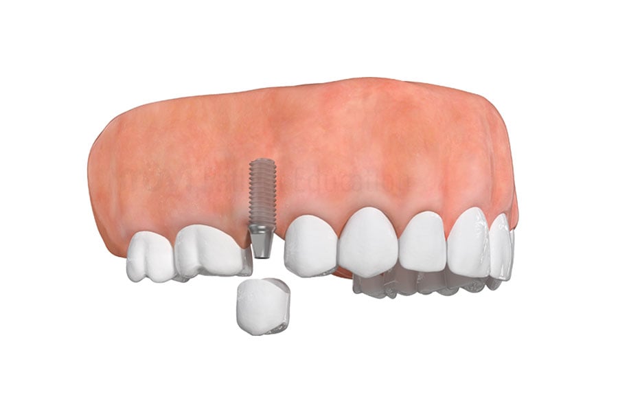 Dental Implants in Bourbonnais, IL