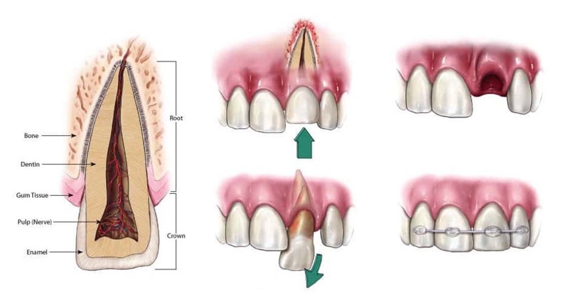 Traumatic Dental Injury in Bourbonnais, IL